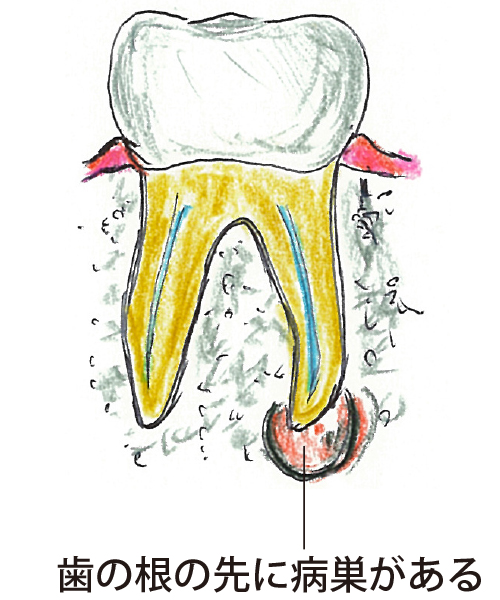 歯の根の先に病巣がある病気。