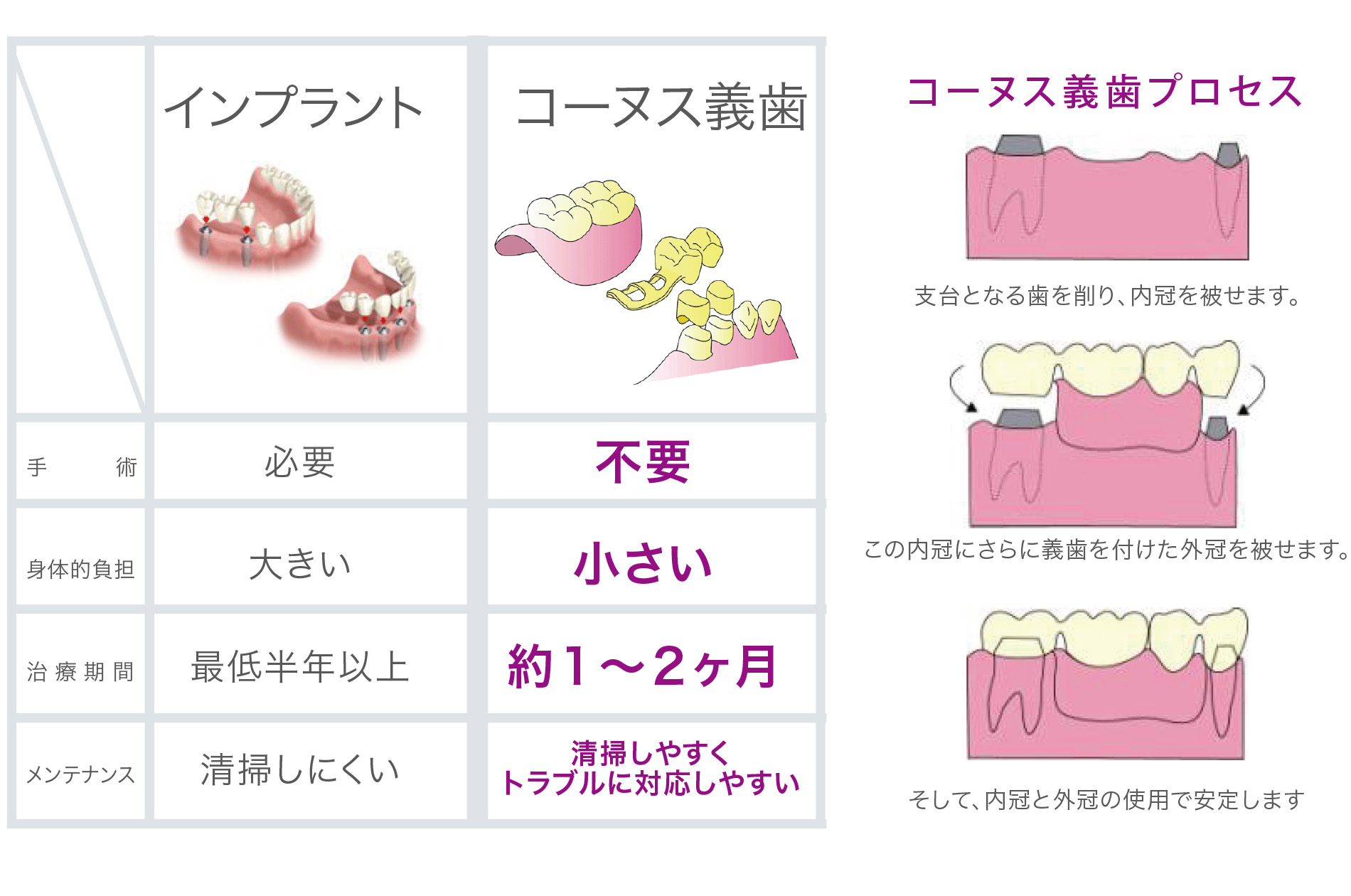 
            コーヌス義歯プロセス
            支台となる歯を削り、内冠を被せます。
            この内冠にさらに義歯を付けた外冠を被せます。
            そして、内冠と外冠の使用で安定します。
            