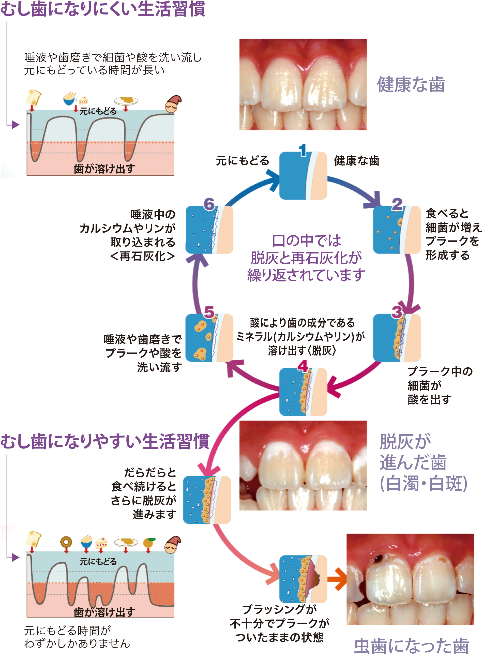 
        表面が白く濁った色になったりザラザラした感じになります。まだ穴はあいていませんが、進行する可能性が高いので注意が必要です。
        (1)白濁・白斑
        上手なケアを行うと、健全な状態に戻ることができます。
        (2)裂溝
        深い歯の溝はむし歯になりやすい部分なので、ケアと観察が重要です。
        歯の表面にあるエナメル質に小さな穴ができます。 痛みなどの自覚症状がほとんどないので、気付かないこともあります。
        エナメル質の奥の象牙質まで むし歯が進んだ状態です。 甘いものや冷たいものが しみるようになってきます。
        歯の神経やその近くまで虫歯に侵されています。 神経が炎症をおこしているので 非常に強い痛みを感じます。
        歯全体が、むし歯に侵されています 歯の根の先に膿がたまったり、 歯のまわりにも 病気の影響がおよび、歯を残すのがむずかしくなります。
        