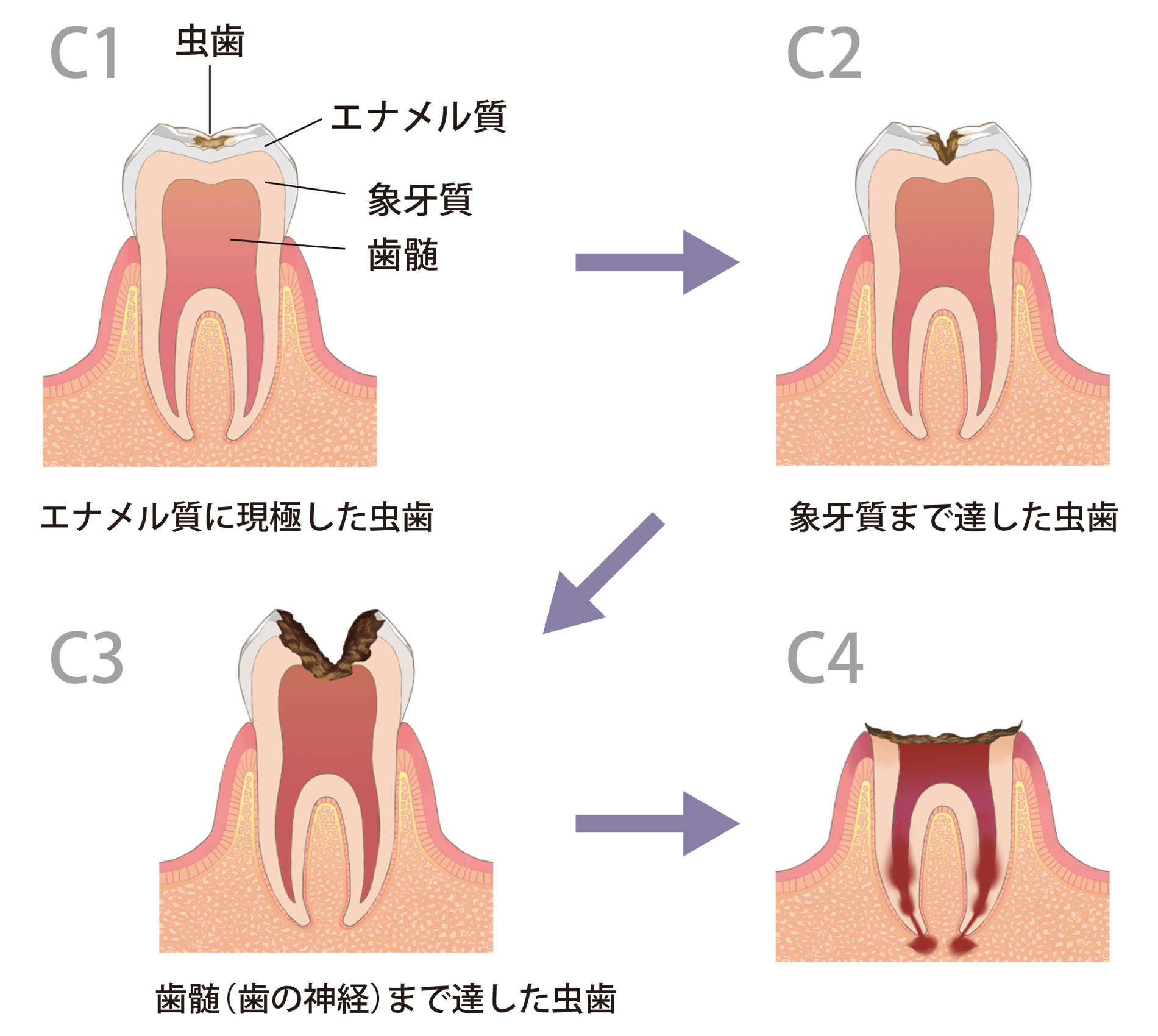 虫歯 の 本数 平均