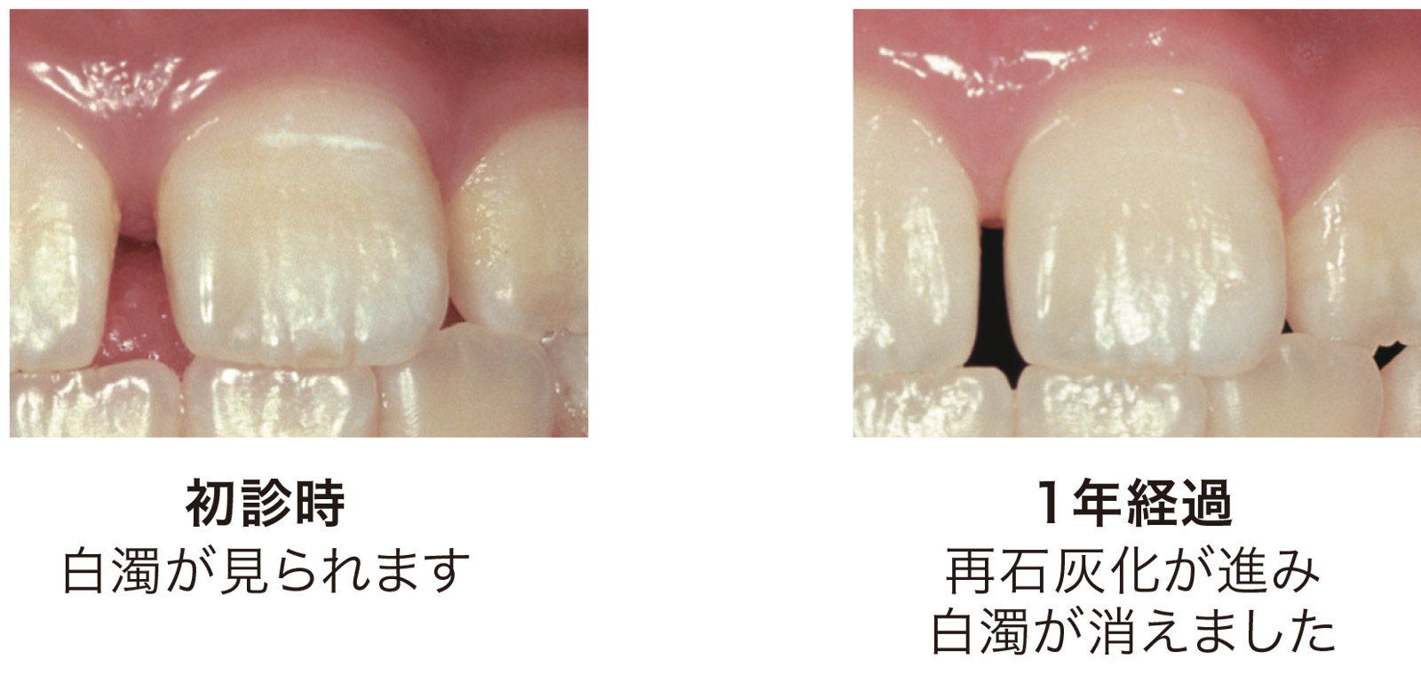 初診時、白濁が見られます。１年経過、再石灰化が進み、白濁が消えました。