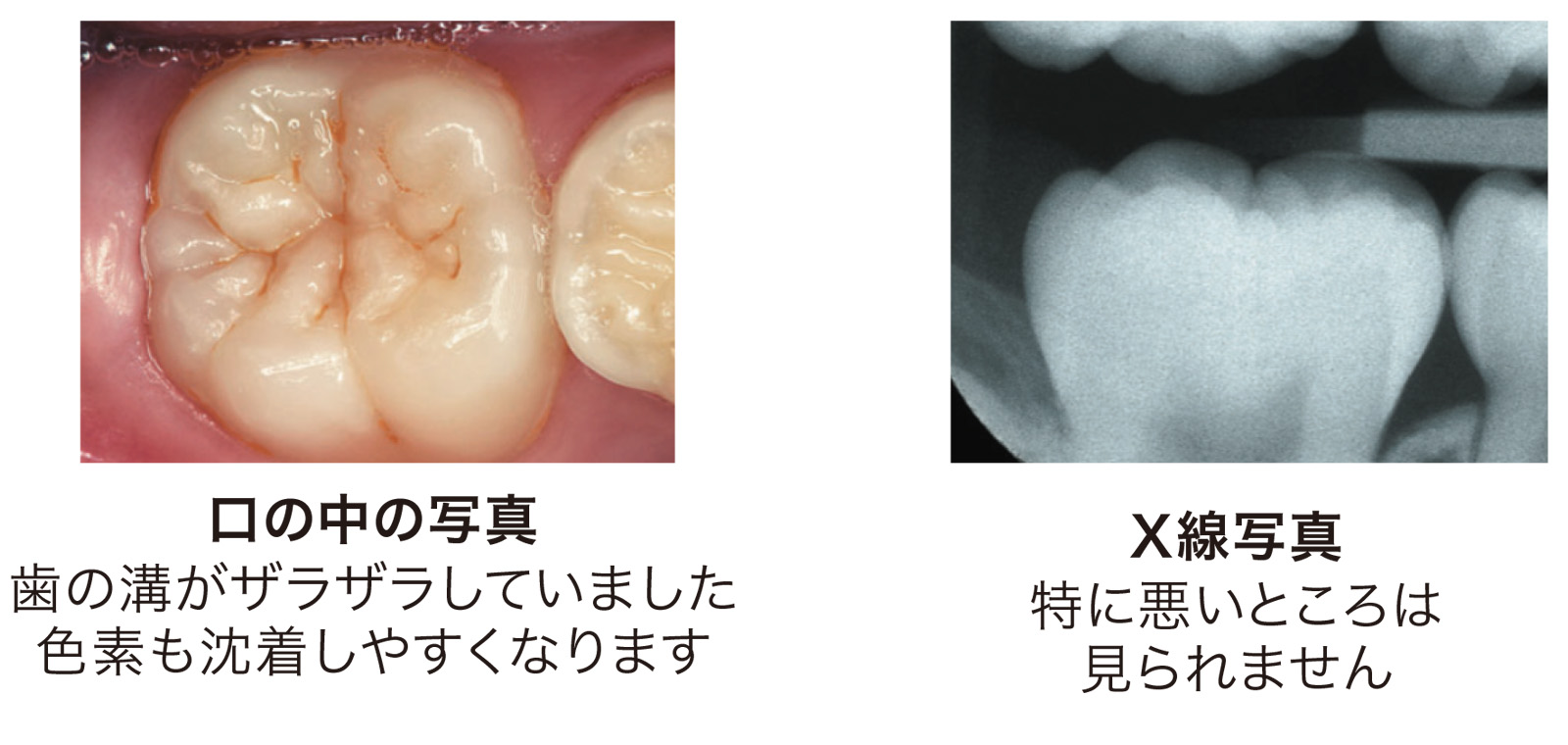 虫歯の進行 一般歯科 タスクデンタルクリニック