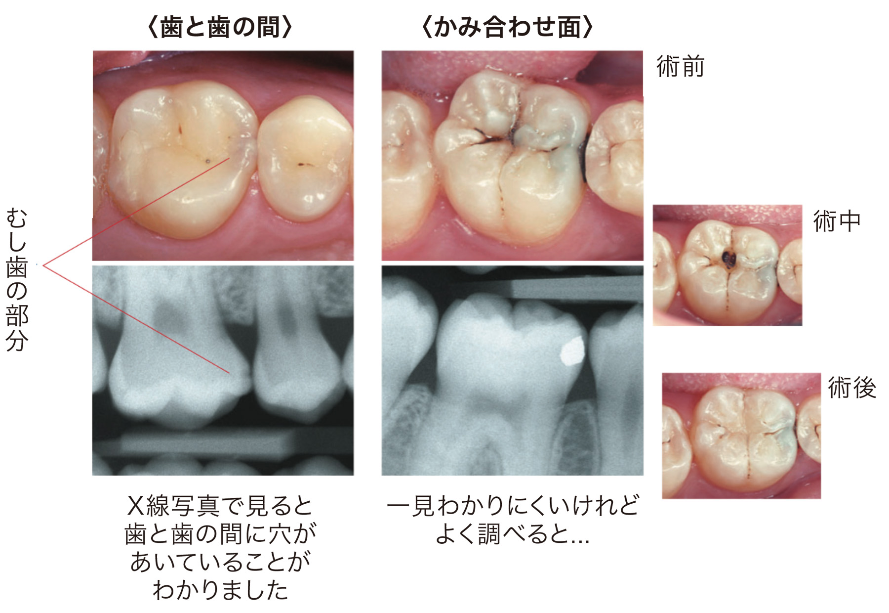 歯と歯の間は、X線写真で見ると歯と歯の間に穴があいていることがわかりました。噛み合わせ面は一見わかりにくいですが、調べてみるとわかります。