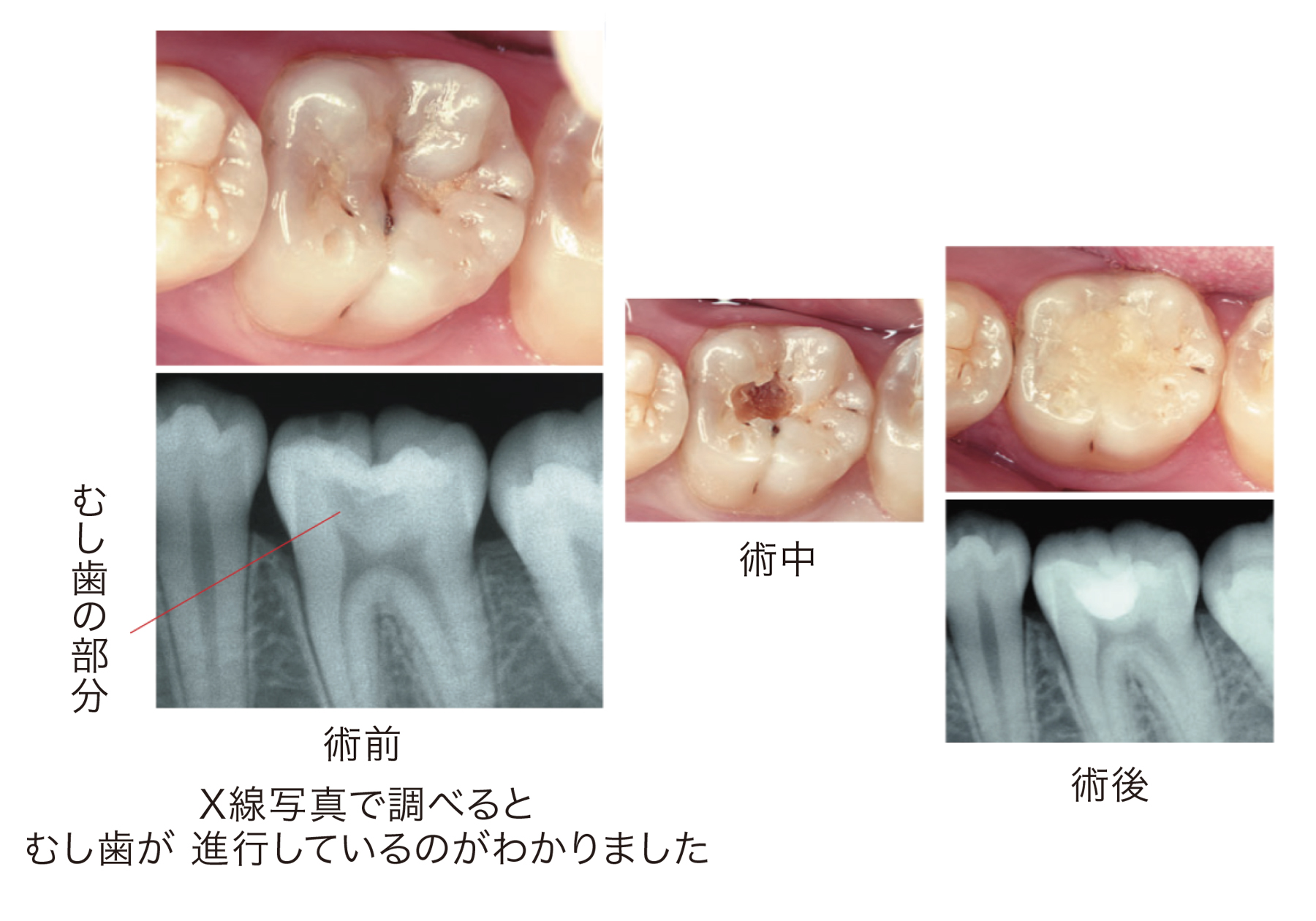 X線写真で調べると虫歯が進行しているのがわかりました。