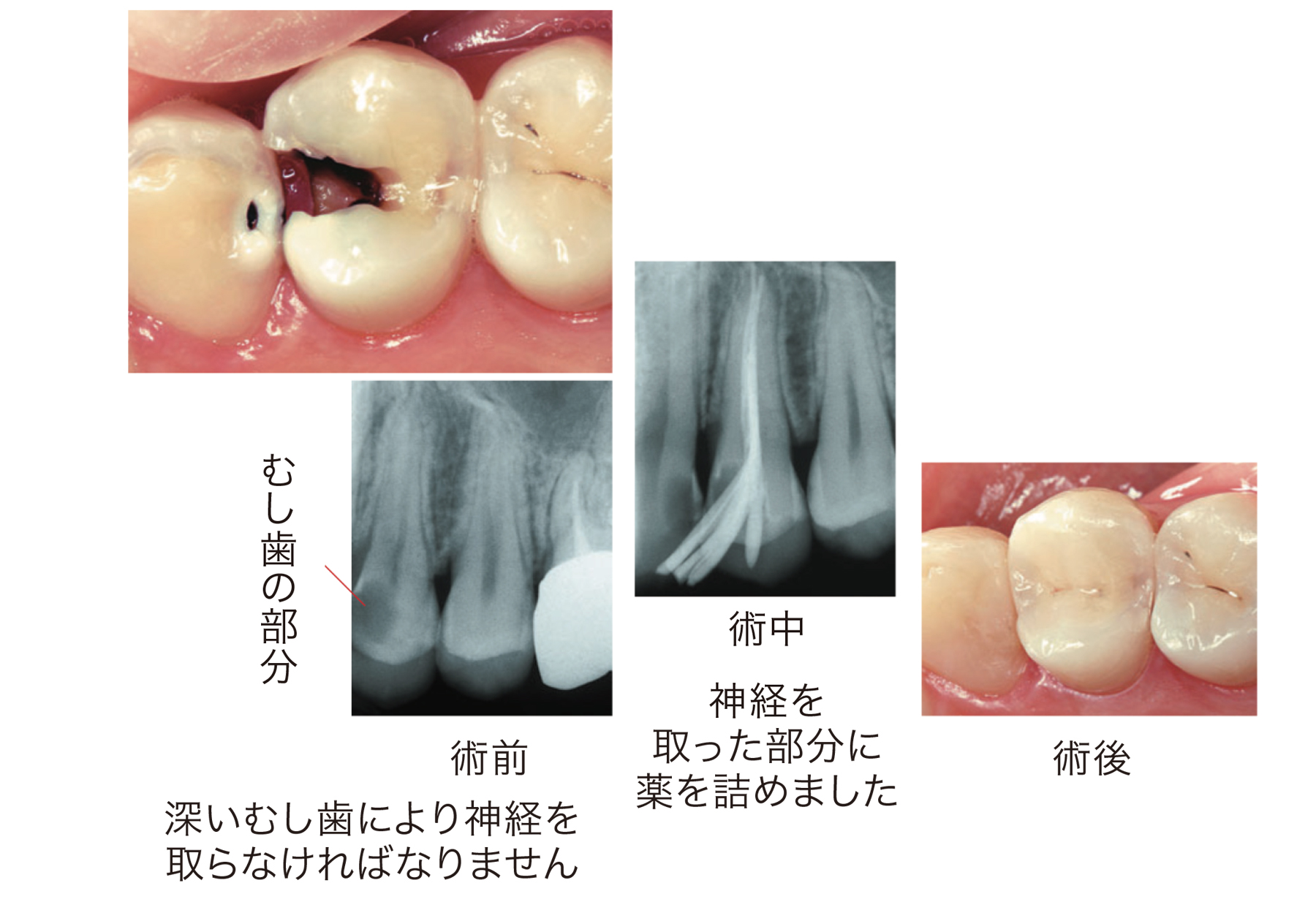 深い虫歯により神経を取らなければなりません。神経を取った部分に薬を詰めました。