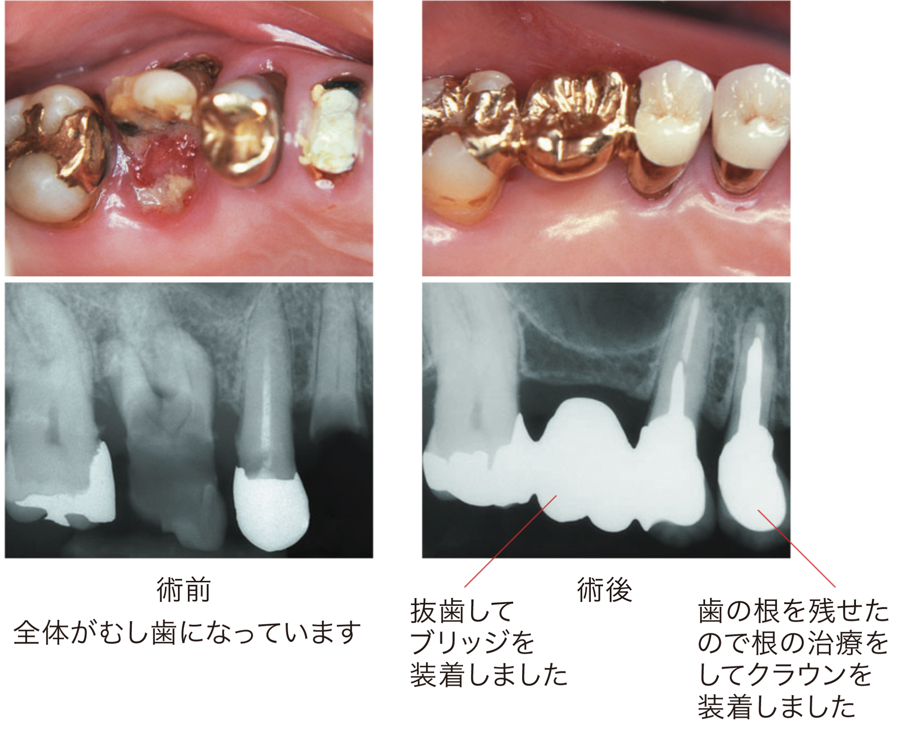 術前は全体が虫歯になっているのに対し、術後は抜歯してブリッジを装着し、歯の根を残せたので根の治療をしてクラウンを装着しました。