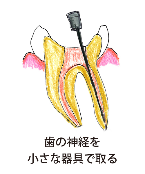 歯の神経を小さな器具で取る