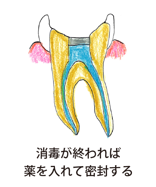 消毒が終われば薬を入れて密封する