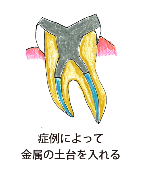 症例によって金属の土台を入れる