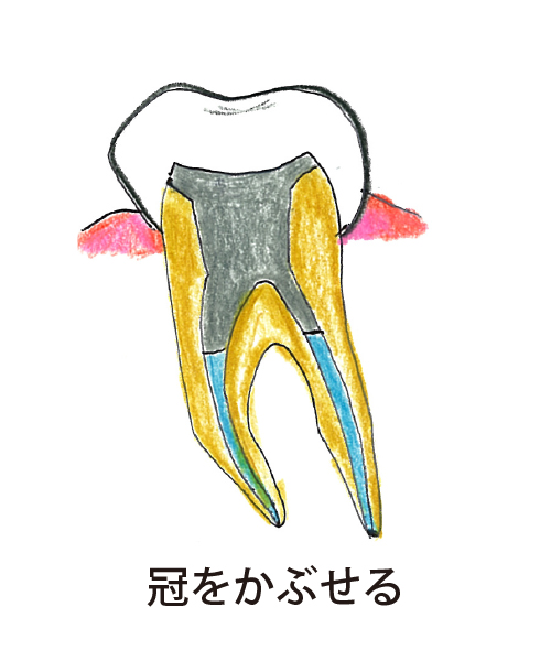 冠をかぶせる