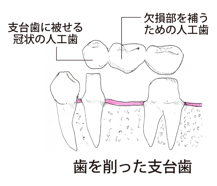 歯を削った支台歯