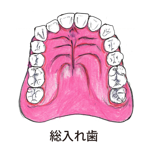 総入れ歯