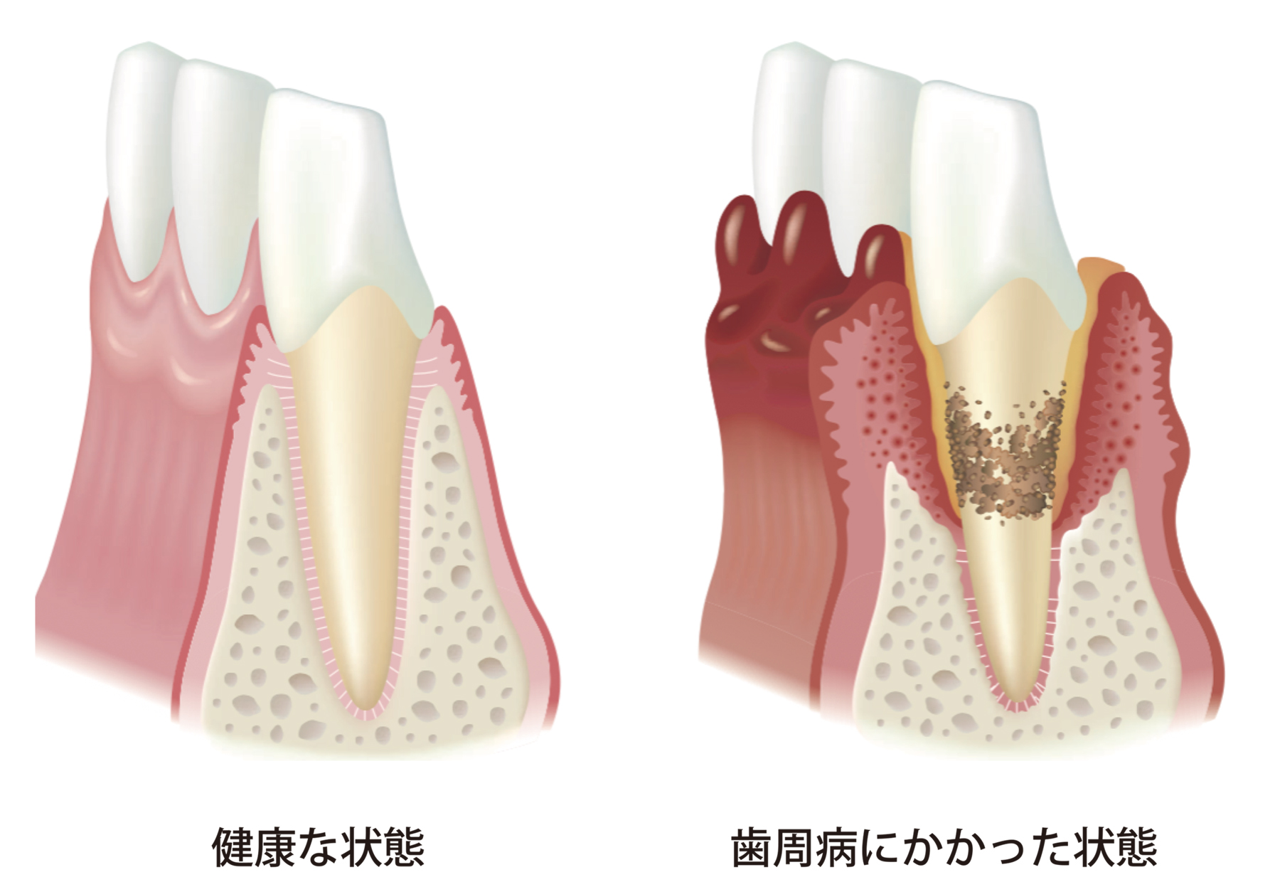 健康な状態、歯周病にかかった状態