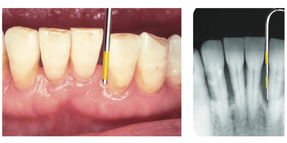 歯周病の検査 一般歯科 | タスクデンタルクリニック