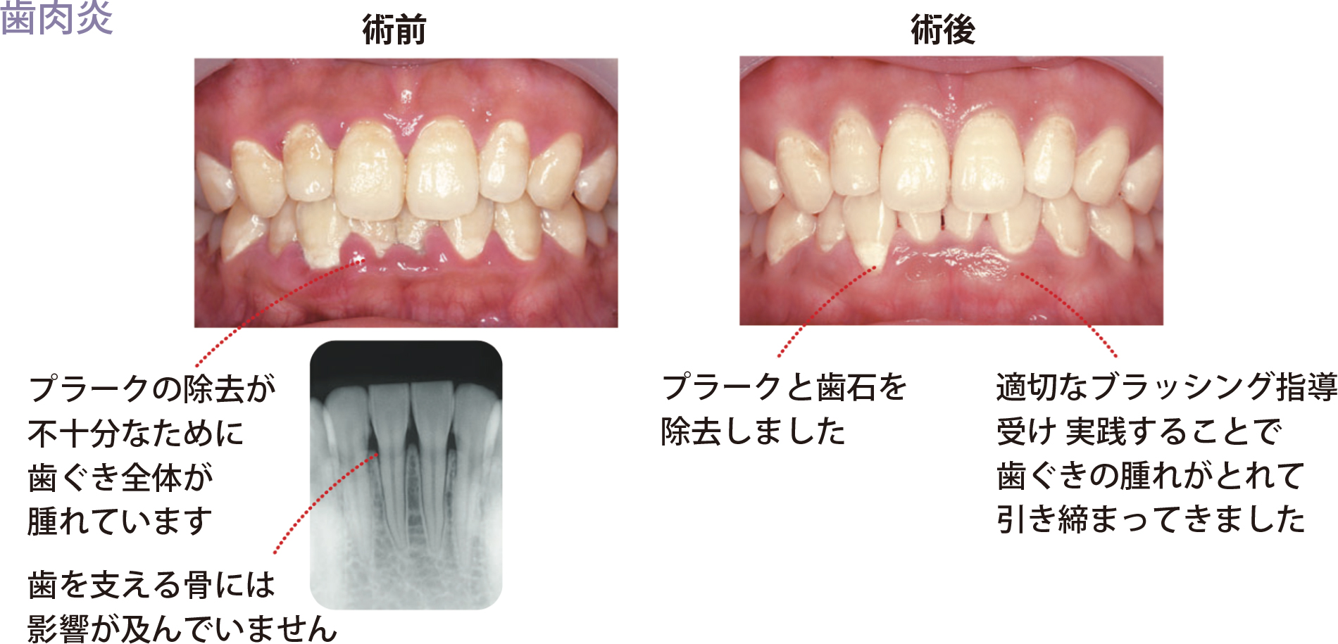 プラークの除去が不十分なために歯ぐき全体が貼れています。歯を支える骨には影響が及んでいません。プラークと歯石を除去し、適切なブラッシング指導を受け、実践することで、歯茎の晴れが取れて引き締まってきました。