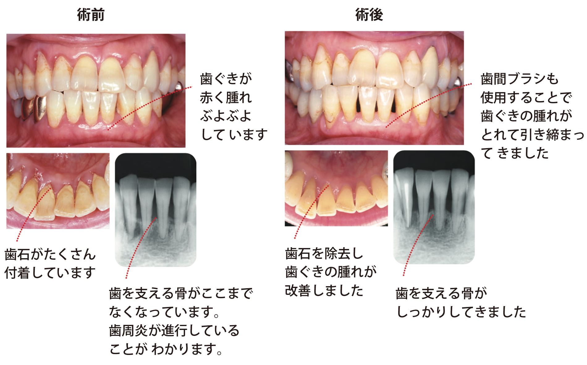 歯ぐきが赤くはれ、ぶよぶよしています。歯石がたくさん付着しており、歯を支える骨がなくなっています。歯周炎が進行していることがわかります。歯間ブラシも併用して治療する事により、歯茎の腫れが取れて引き締まってきます。歯石を除去し、歯ぐきの腫れが改善してきます。歯を支える骨もしっかりしてきます。