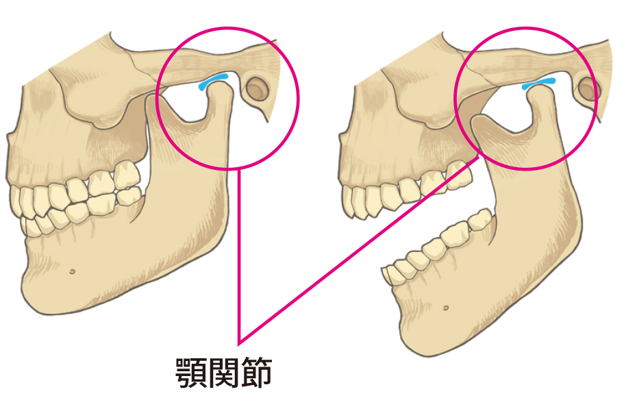 顎 関節 症 噛み 合わせ が 変わっ た