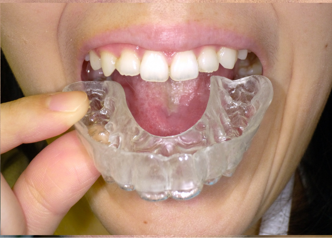 歯ぎしり 一般歯科 タスクデンタルクリニック