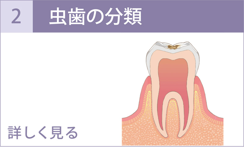 虫歯の分類