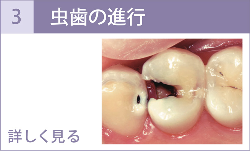 抜き 親知らず 糸 大人の親知らずは抜くべき？抜歯後の痛み・腫れの予防・軽減方法などを解説【歯科医師監修】