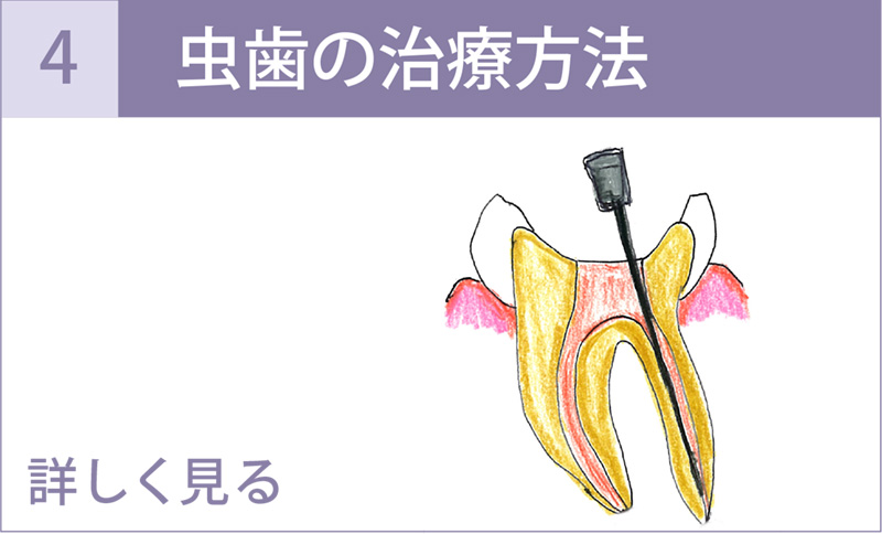 虫歯の治療方法