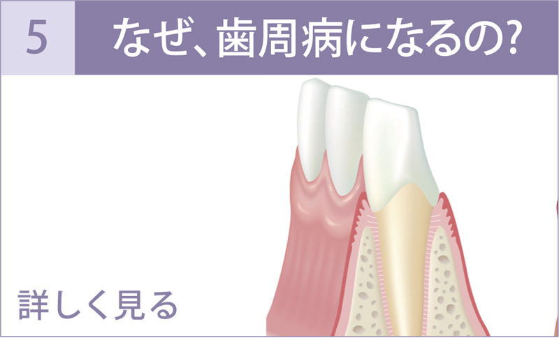 なぜ、歯周病になるの？