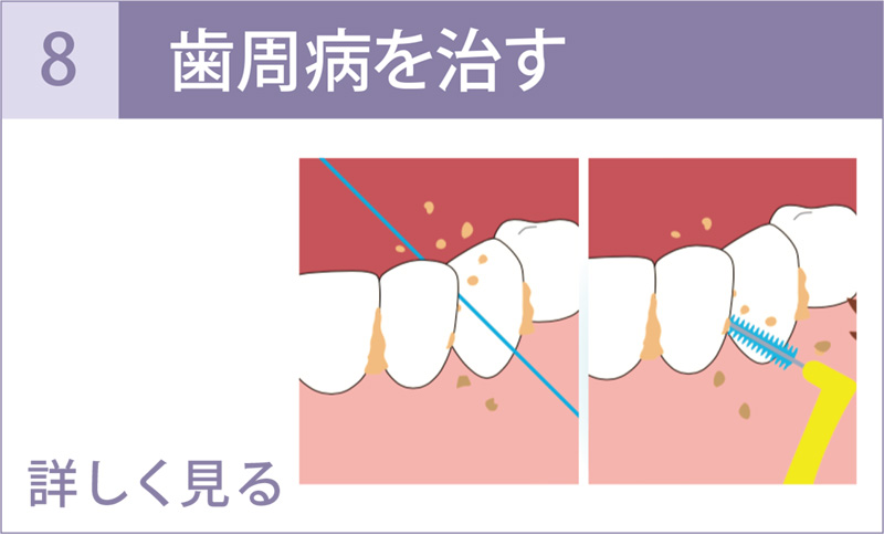 歯周病を治す