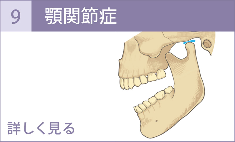 顎関節症