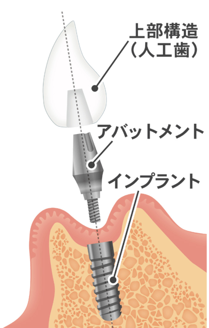 上部構造と、アパットメント、インプラントの接続