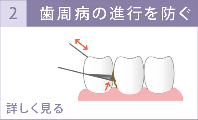 歯周病の進行を防ぐ